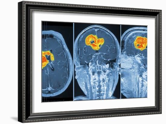 Brain Tumour, MRI Scan-PASIEKA-Framed Photographic Print