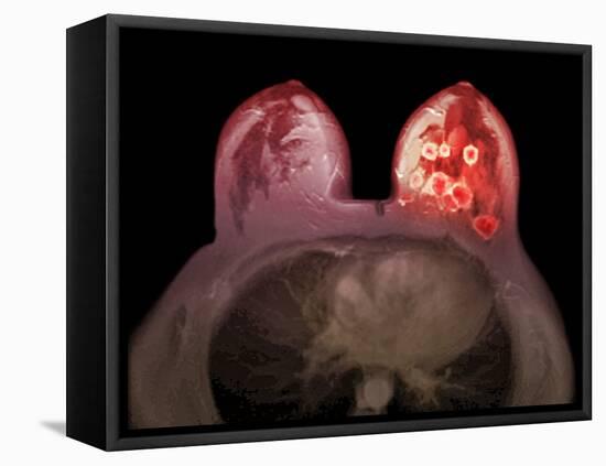 Breast Cancer, MRI Scan-Du Cane Medical-Framed Premier Image Canvas