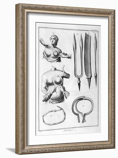 Breast Surgery, 1751-1777-Denis Diderot-Framed Giclee Print