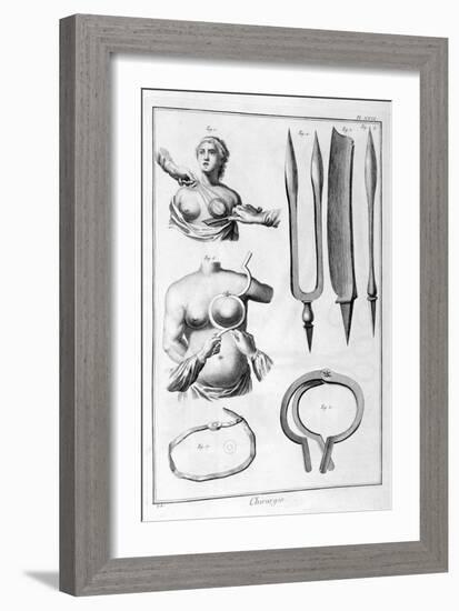 Breast Surgery, 1751-1777-Denis Diderot-Framed Giclee Print