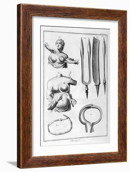 Breast Surgery, 1751-1777-Denis Diderot-Framed Giclee Print