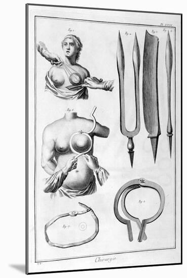 Breast Surgery, 1751-1777-Denis Diderot-Mounted Giclee Print