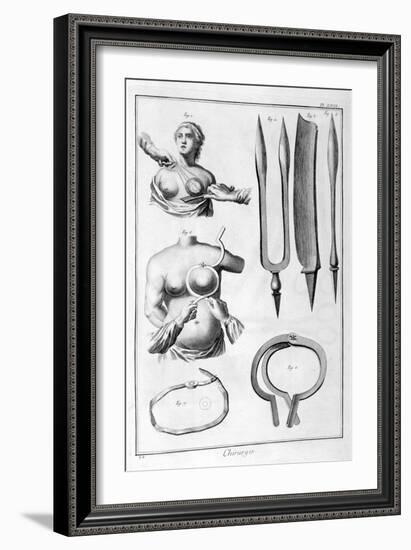 Breast Surgery, 1751-1777-Denis Diderot-Framed Giclee Print