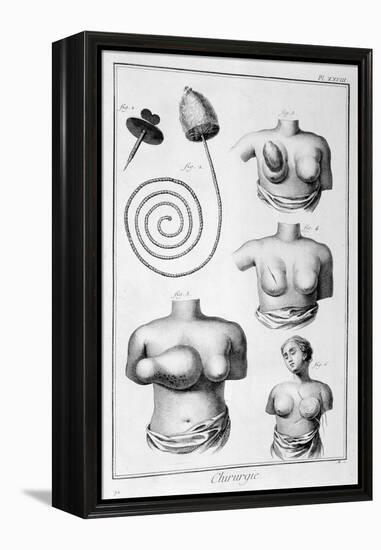 Breast Surgery, 1751-1777-Denis Diderot-Framed Premier Image Canvas