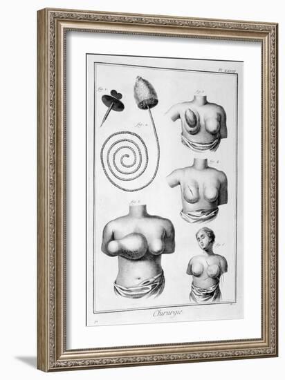 Breast Surgery, 1751-1777-Denis Diderot-Framed Giclee Print