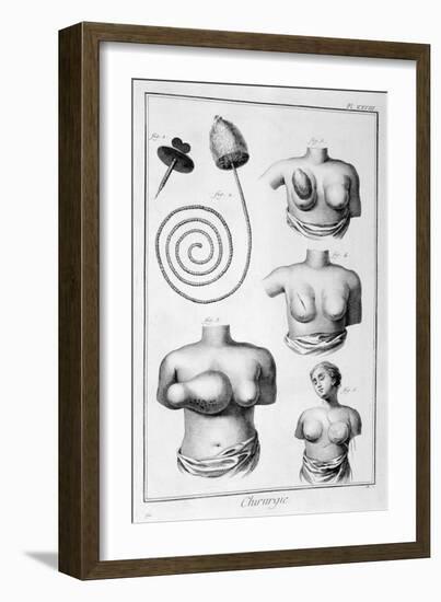 Breast Surgery, 1751-1777-Denis Diderot-Framed Giclee Print