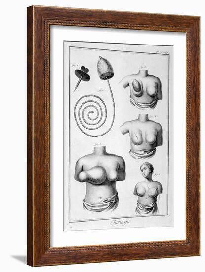 Breast Surgery, 1751-1777-Denis Diderot-Framed Giclee Print