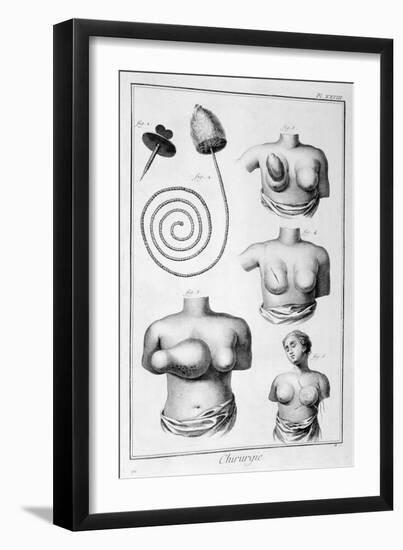 Breast Surgery, 1751-1777-Denis Diderot-Framed Giclee Print