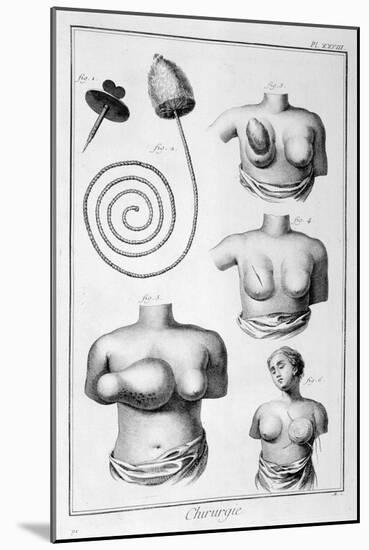 Breast Surgery, 1751-1777-Denis Diderot-Mounted Giclee Print