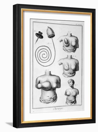 Breast Surgery, 1751-1777-Denis Diderot-Framed Giclee Print