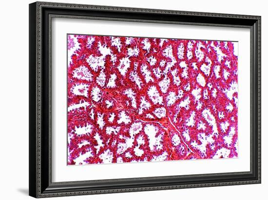 Breast Tissue, Light Micrograph-Dr. Keith Wheeler-Framed Photographic Print