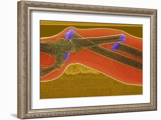 Broken Arm And Dislocated Wrist-Du Cane Medical-Framed Photographic Print