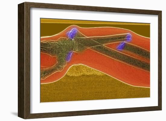 Broken Arm And Dislocated Wrist-Du Cane Medical-Framed Photographic Print