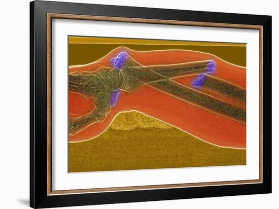 Broken Arm And Dislocated Wrist-Du Cane Medical-Framed Photographic Print