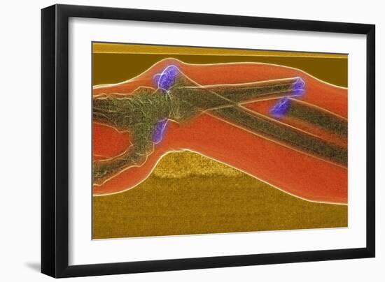Broken Arm And Dislocated Wrist-Du Cane Medical-Framed Photographic Print