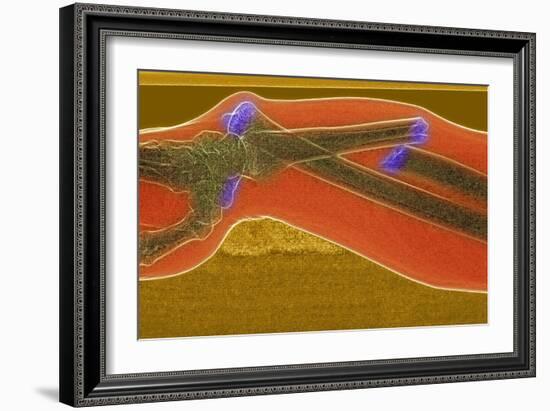 Broken Arm And Dislocated Wrist-Du Cane Medical-Framed Photographic Print