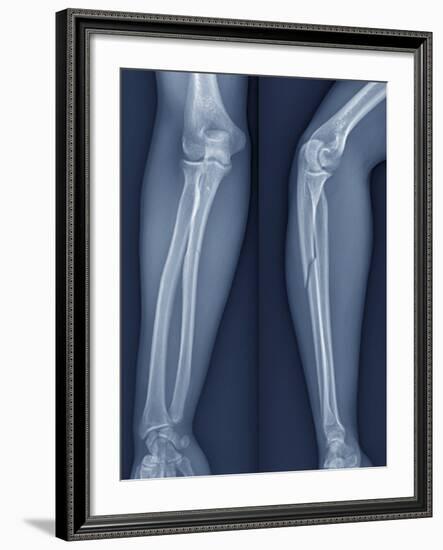 Broken Arm, X-ray-ZEPHYR-Framed Photographic Print