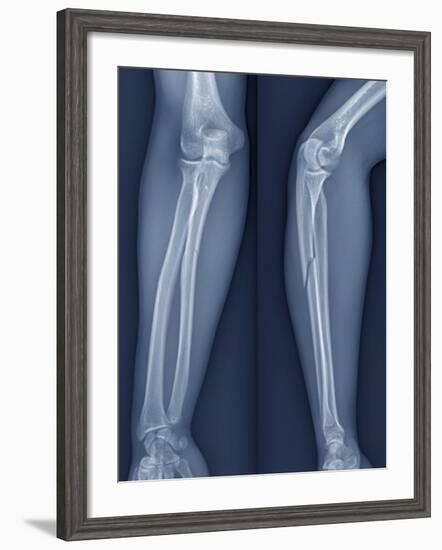 Broken Arm, X-ray-ZEPHYR-Framed Photographic Print