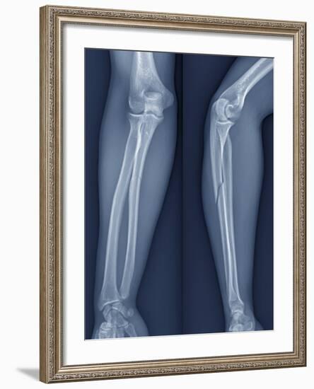 Broken Arm, X-ray-ZEPHYR-Framed Photographic Print