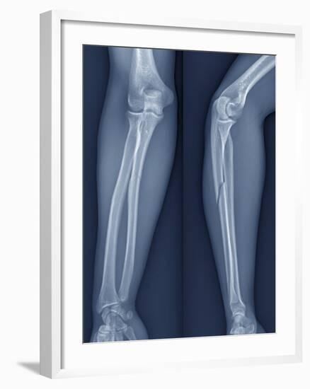 Broken Arm, X-ray-ZEPHYR-Framed Photographic Print