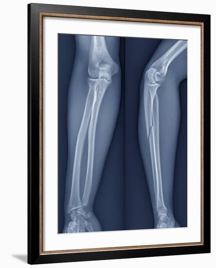 Broken Arm, X-ray-ZEPHYR-Framed Photographic Print