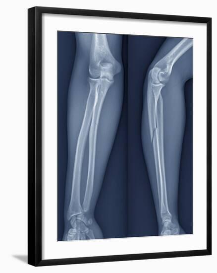 Broken Arm, X-ray-ZEPHYR-Framed Photographic Print