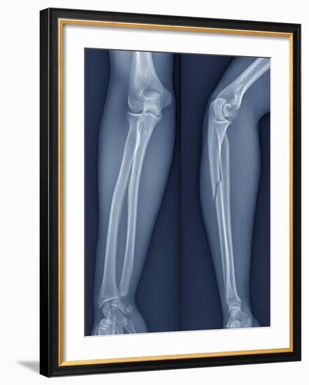 Broken Arm, X-ray-ZEPHYR-Framed Photographic Print