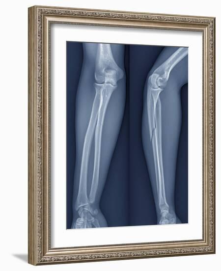 Broken Arm, X-ray-ZEPHYR-Framed Photographic Print