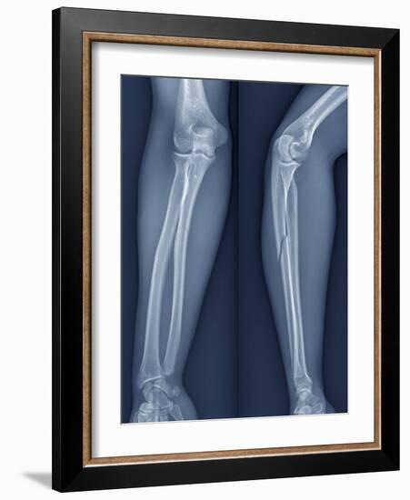 Broken Arm, X-ray-ZEPHYR-Framed Photographic Print