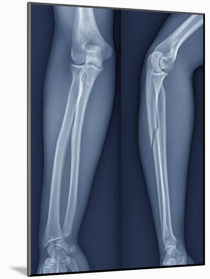 Broken Arm, X-ray-ZEPHYR-Mounted Photographic Print