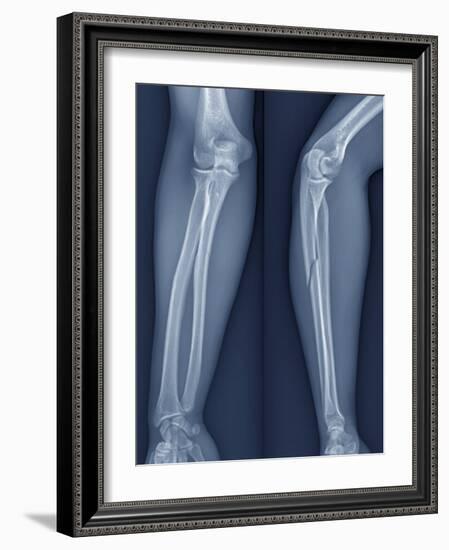 Broken Arm, X-ray-ZEPHYR-Framed Photographic Print