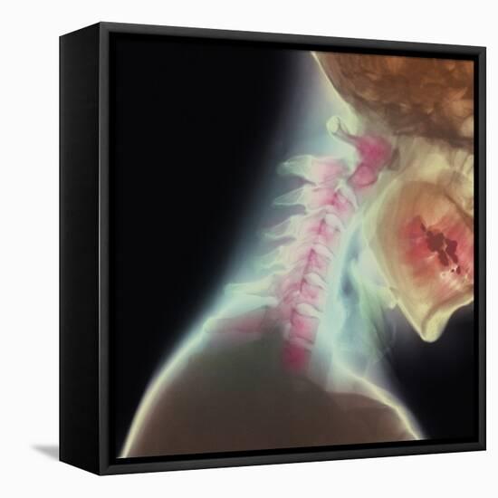 Broken Neck-Science Photo Library-Framed Premier Image Canvas