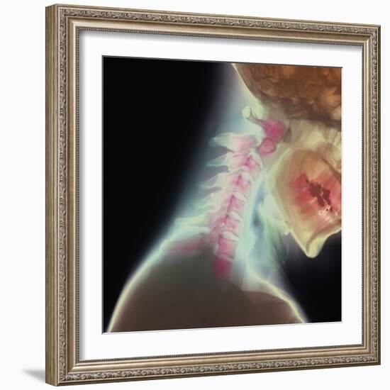 Broken Neck-Science Photo Library-Framed Premium Photographic Print