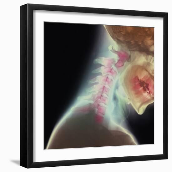 Broken Neck-Science Photo Library-Framed Premium Photographic Print