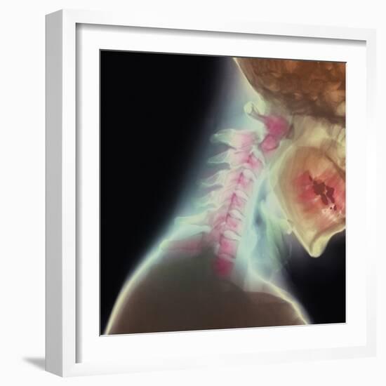 Broken Neck-Science Photo Library-Framed Premium Photographic Print