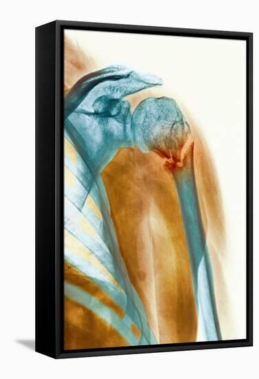 Broken Upper Arm Bone, X-ray-Science Photo Library-Framed Premier Image Canvas
