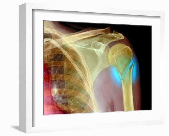 Broken Upper Arm Bone, X-ray-Du Cane Medical-Framed Photographic Print