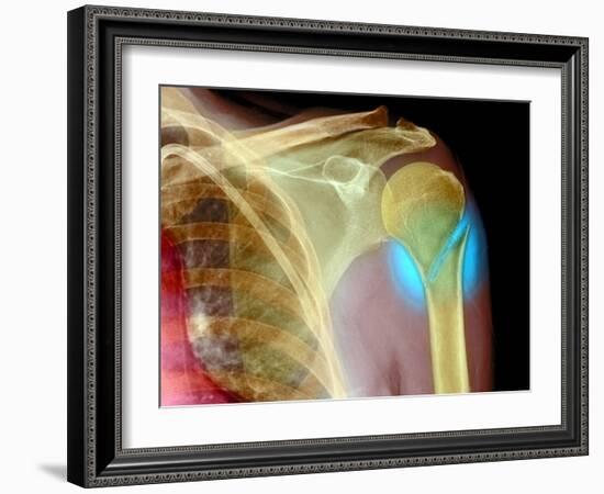 Broken Upper Arm Bone, X-ray-Du Cane Medical-Framed Photographic Print