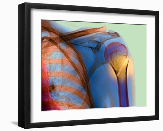 Broken Upper Arm Bone, X-ray-Du Cane Medical-Framed Photographic Print