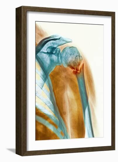 Broken Upper Arm Bone, X-ray-Science Photo Library-Framed Photographic Print