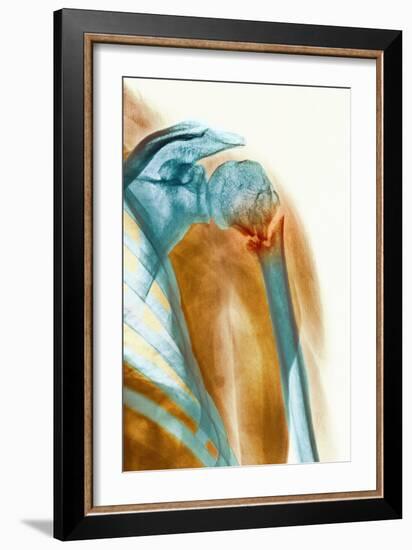 Broken Upper Arm Bone, X-ray-Science Photo Library-Framed Photographic Print