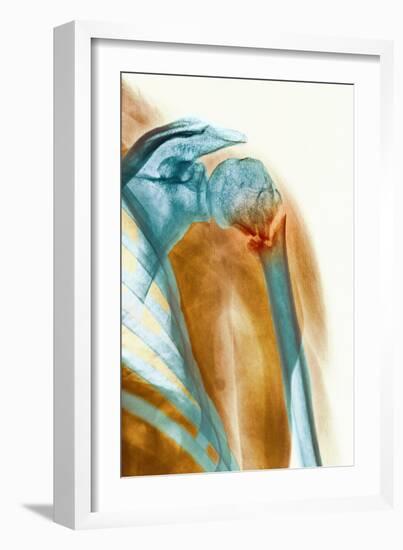 Broken Upper Arm Bone, X-ray-Science Photo Library-Framed Photographic Print