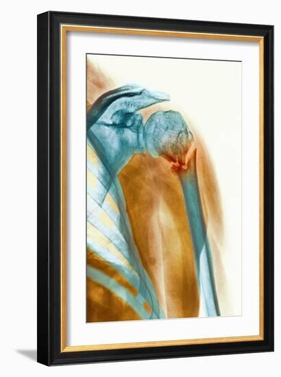 Broken Upper Arm Bone, X-ray-Science Photo Library-Framed Photographic Print