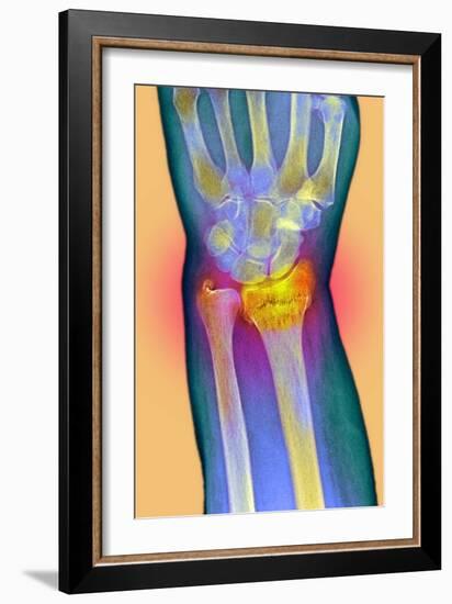 Broken Wrist, X-ray-Du Cane Medical-Framed Photographic Print