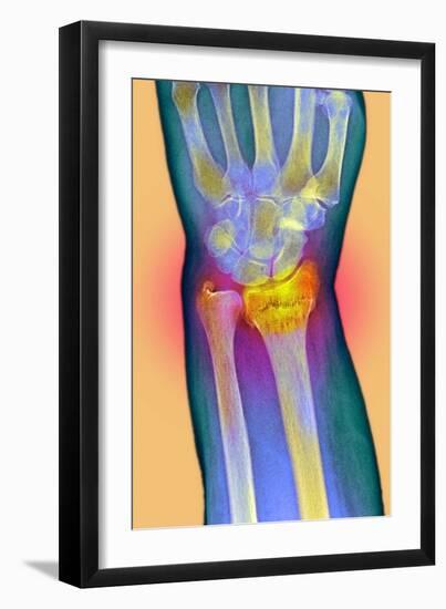 Broken Wrist, X-ray-Du Cane Medical-Framed Photographic Print