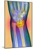 Broken Wrist, X-ray-Du Cane Medical-Mounted Photographic Print