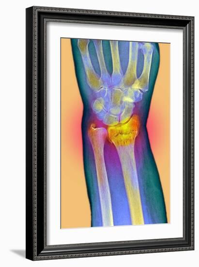 Broken Wrist, X-ray-Du Cane Medical-Framed Photographic Print
