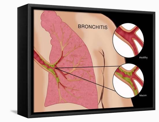 Bronchitis-Monica Schroeder-Framed Premier Image Canvas