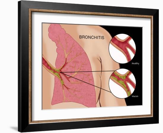 Bronchitis-Monica Schroeder-Framed Giclee Print