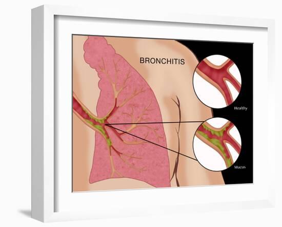 Bronchitis-Monica Schroeder-Framed Giclee Print